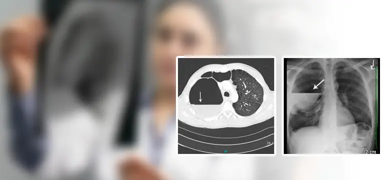 Exploring the Role of PET Scan in diagnosing active lung Bullae